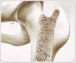 Bone fracture risk rises after women stop menopausal hormone treatment