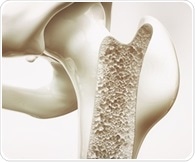 Bone fracture risk rises after women stop menopausal hormone treatment