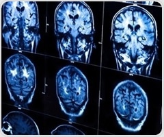 Gene editing in the brain offers hope for ultra-rare neurological disease