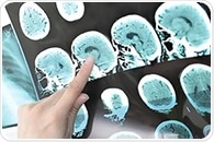 Deep learning method enhances vessel and plaque segmentation in stroke diagnosis