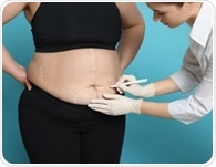 Patients face vitamin deficiencies years after bariatric surgery