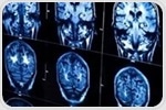 Gene editing in the brain offers hope for ultra-rare neurological disease