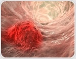 Early screening linked to spike in early-stage colon cancer diagnoses