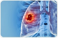 Lipid droplet protein perilipin 2 linked to poor prognosis in lung cancer