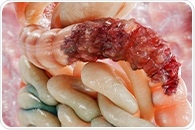Advancing precision medicine in colorectal cancer with multi-omics approaches