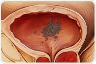 New drug-releasing system eliminates tumors in 82% of high-risk bladder cancer patients
