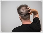 Sugary drinks increase hair loss risk, scientists warn