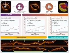 AI scans arteries and predicts risk after heart attack better than traditional review