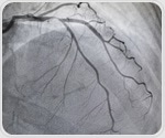 Evolocumab fails to reduce vein graft disease after coronary artery bypass surgery