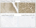 Claudin 18.2-specific antibodies for population screening and clinical diagnosis