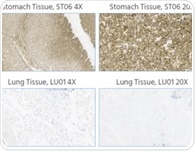 Claudin 18.2-specific antibodies for population screening and clinical diagnosis