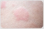 Understanding immune drift in biologic therapy for inflammatory skin diseases