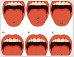 Do tongue piercings harm your oral health? Evidence points to yes