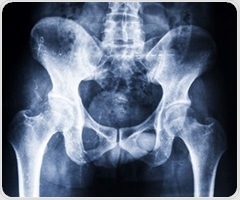 Molecular breast imaging increases overall invasive cancer detection in women with dense breasts