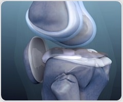 Aerobic exercise found to be most effective for knee osteoarthritis