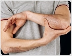 Low-calorie diets linked to higher psoriatic arthritis risk, genetic study suggests