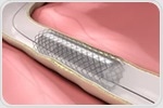 Landmark trial shows drug-eluting balloon as effective option for in-stent restenosis