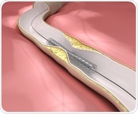 Sirolimus-eluting balloon emerges as a safe and effective option for coronary in-stent restenosis