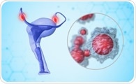 Polymer-Coated Nanoparticles Target and Clear Disseminated Ovarian Cancer