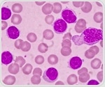 Combination therapy offers hope for ending lifelong chronic lymphocytic leukemia treatment