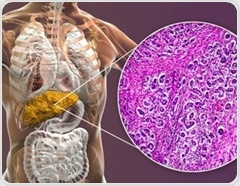 Blood group A linked to a higher risk of primary biliary cholangitis