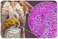 Blood group A linked to a higher risk of primary biliary cholangitis