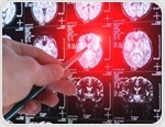 Lecanemab doesn’t improve early brain waste-clearance in Alzheimer’s