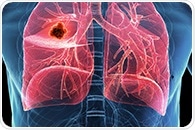 World’s first experimental lung cancer vaccine to enter clinical trials