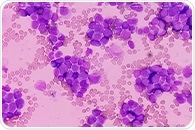New medication offers potential treatment for patients with deadliest form of blood cancer