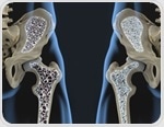Routine blood test may flag hidden osteoporosis risk, study finds