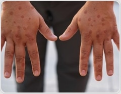 Study explains why mpox cases can appear weeks after exposure