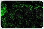 This Fluorescent Membrane Spots Pancreatic Cancer Marker with a Simple Color Change