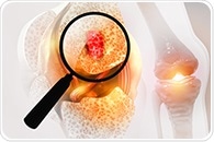 Bifunctional biomaterials for postoperative management of osteosarcoma