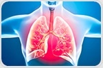 Researchers develop AI-powered method for faster lung infection diagnosis