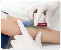 Blood test opens the doors to early diagnosis and prevention of Crohn's disease