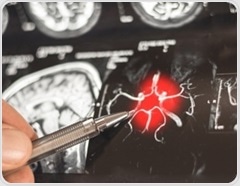 Evidence links gut microbiome changes to Alzheimer’s progression