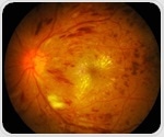 Posture-induced retinal vascular response predicts diabetic retinopathy progression