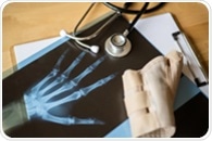 A routine blood test may reveal who is most at risk of osteoporosis