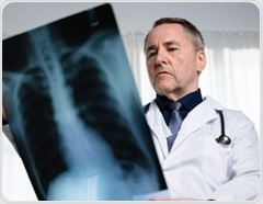 Why lung cancer in never smokers is rising and how targeted detection could reduce deaths
