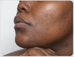 Skin of color seminar improves medical students’ diagnosis skills