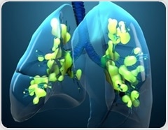 COVID-19 ARDS survivors face lasting disability and high late mortality, researchers report