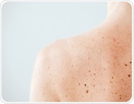 Psoriasis-Like Inflammation Limits Skin Cancer Growth