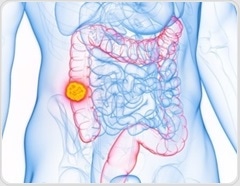 Tumor debulking fails to improve survival in colorectal cancer