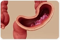 The Role of the Gut Microbiome in Gastrointestinal Cancer Development