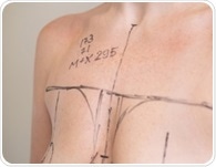 Breast reduction surgery is linked to lower diabetes and heart risk