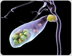 Higher sugar intake raises gallstone risk in adults, study finds