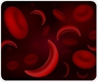 Gene-edited treatment shows promising outcomes for severe sickle cell disease