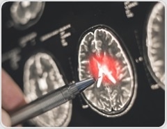 High-dose flu shots inked to lower Alzheimer's dementia risk in older adults