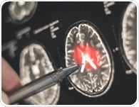 High-dose flu shots inked to lower Alzheimer's dementia risk in older adults