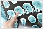 Collaboration advances EMA601 as potential first-in-class stroke therapy
